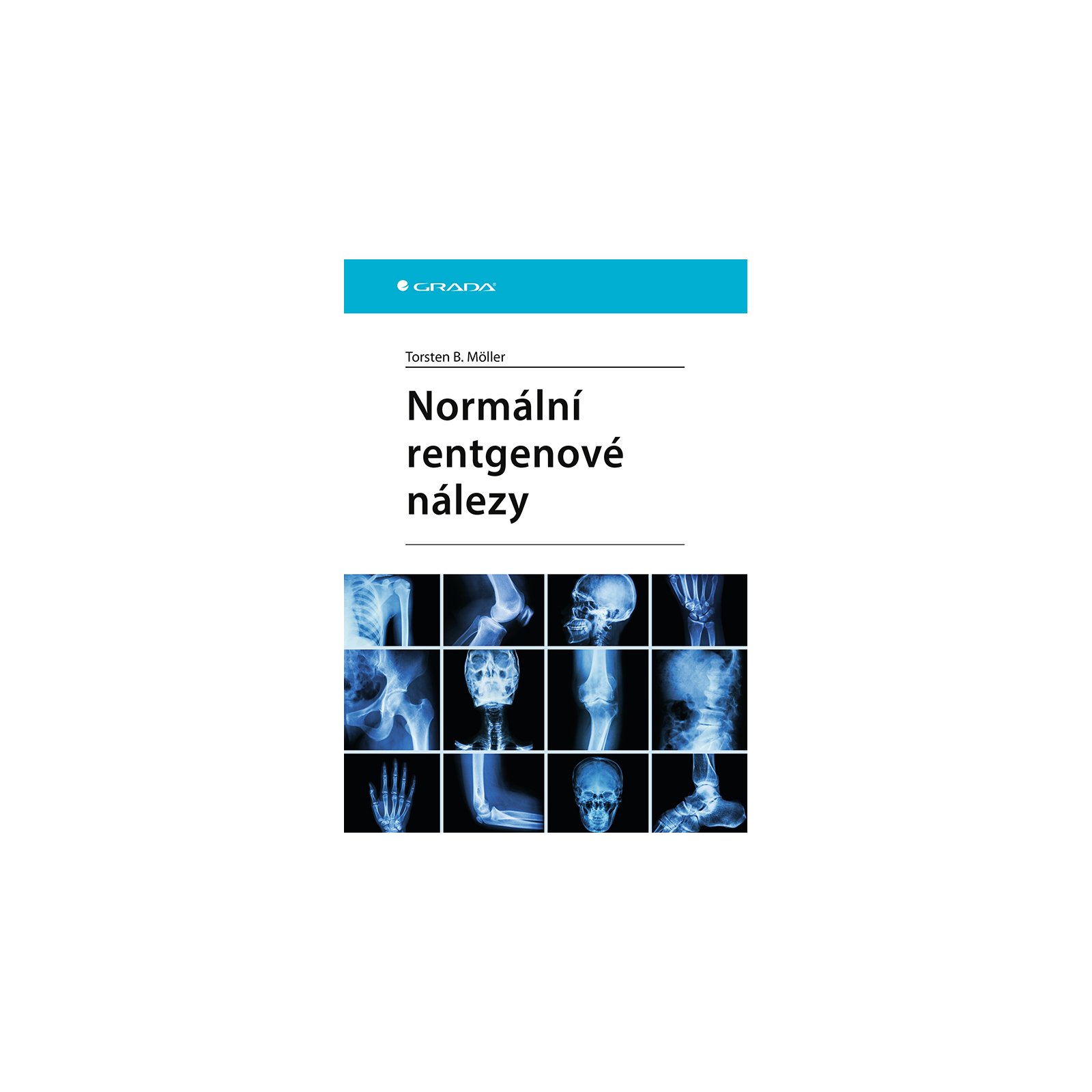 Normální rentgenové nálezy