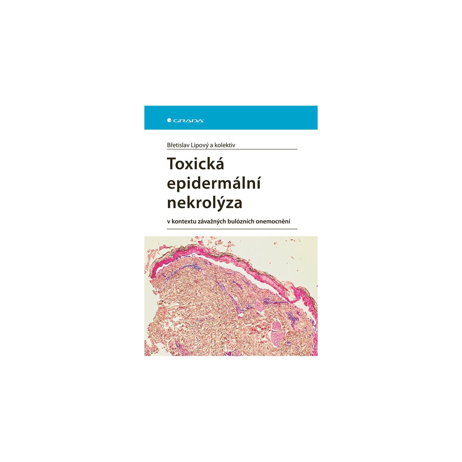 Toxická epidermální nekrolýza